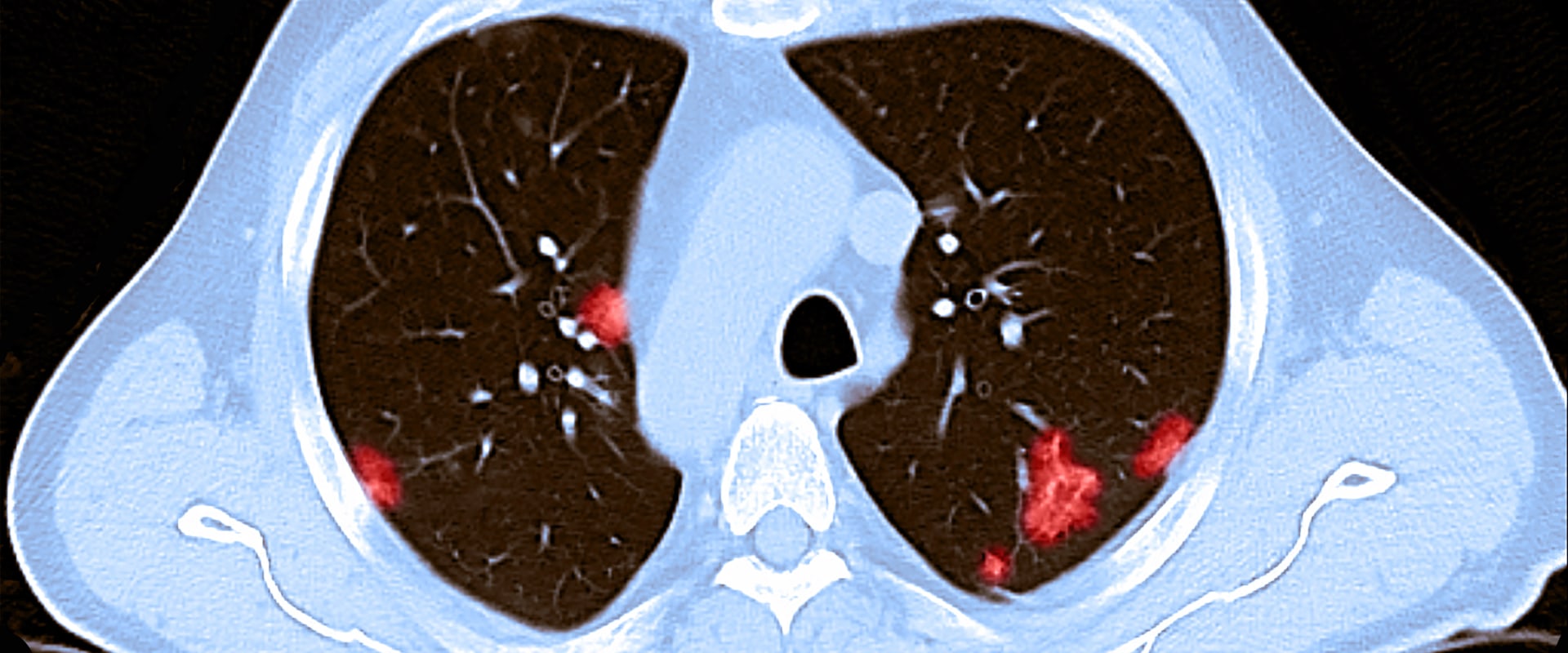 Is Covid-19 Lung Damage Reversible?