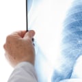 Can lungs heal after 20 years of smoking?