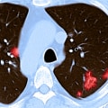 Is Covid-19 Lung Damage Reversible?