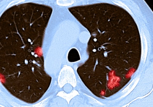 Is Covid-19 Lung Damage Reversible?